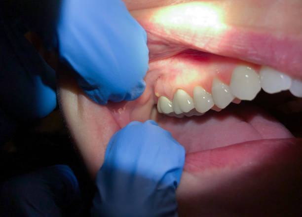 Best Emergency Dental Care for Abscessed Tooth in Cross Plains, TN
